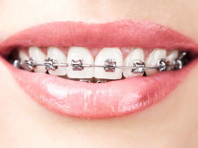 https://angelakopouloudental.gr/wp-content/uploads/2020/01/post_05-640x480.jpg
